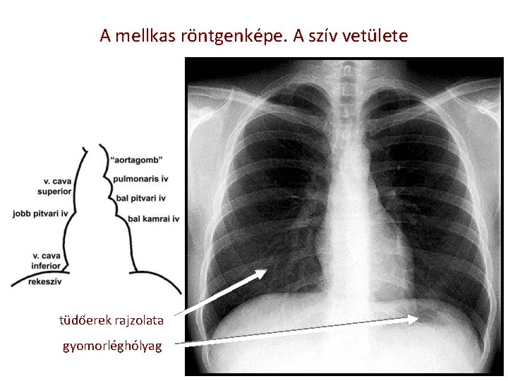 A mellkas röntgenképe. A szív vetülete tüdőerek rajzolata gyomorléghólyag 