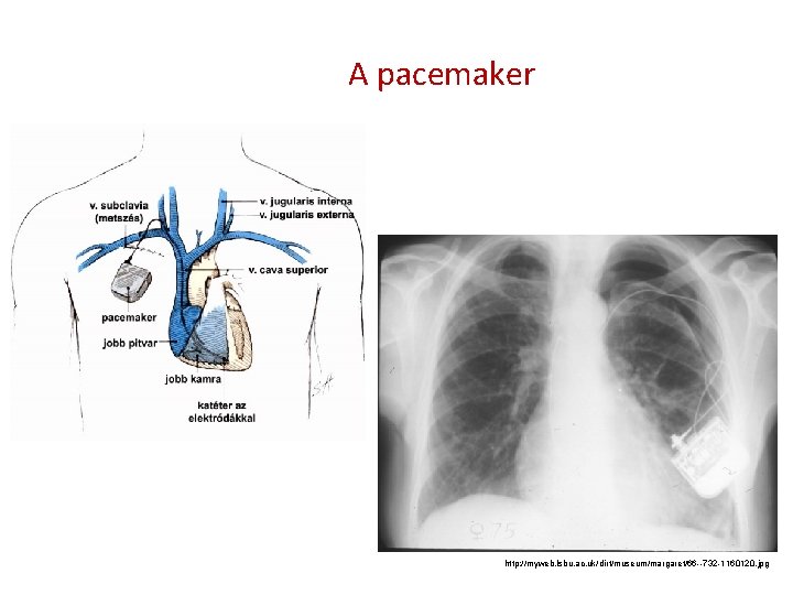 A pacemaker http: //myweb. lsbu. ac. uk/dirt/museum/margaret/66 --732 -1160120. jpg 