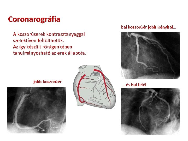 Coronarográfia bal koszorúér jobb irányból… A koszorúserek kontrasztanyaggal szelektíven feltölthetők. Az így készült röntgenképen