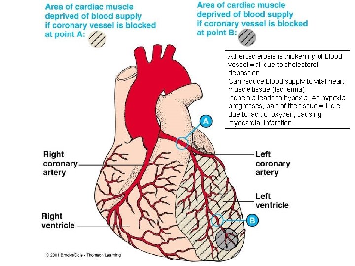 Atherosclerosis is thickening of blood vessel wall due to cholesterol deposition Can reduce blood