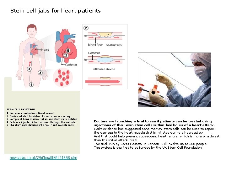 Stem cell jabs for heart patients STEM-CELL INJECTION 1 Catheter inserted into blood vessel