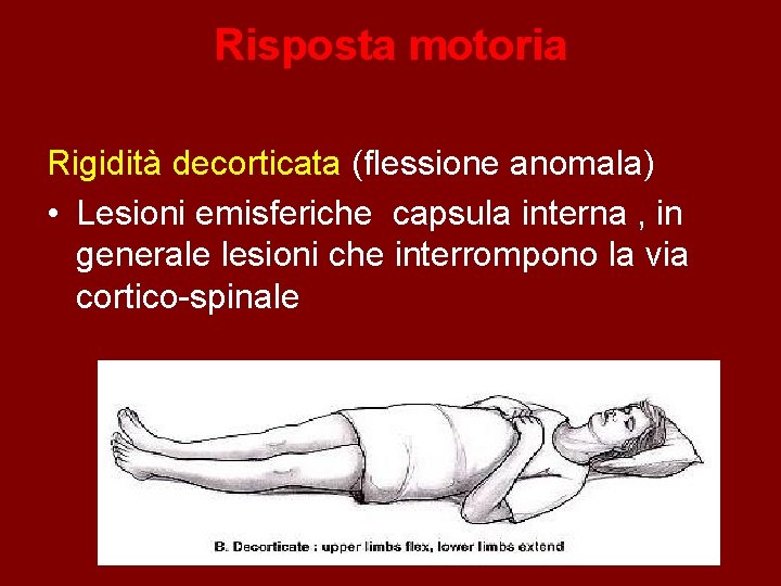 Risposta motoria Rigidità decorticata (flessione anomala) • Lesioni emisferiche capsula interna , in generale