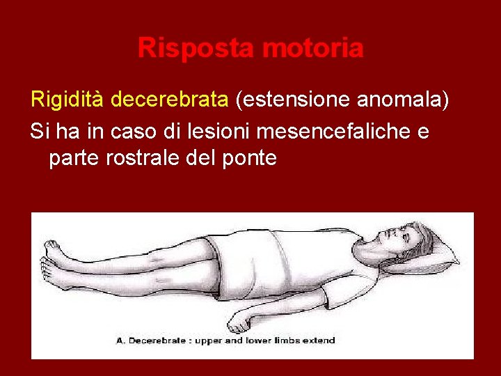 Risposta motoria Rigidità decerebrata (estensione anomala) Si ha in caso di lesioni mesencefaliche e