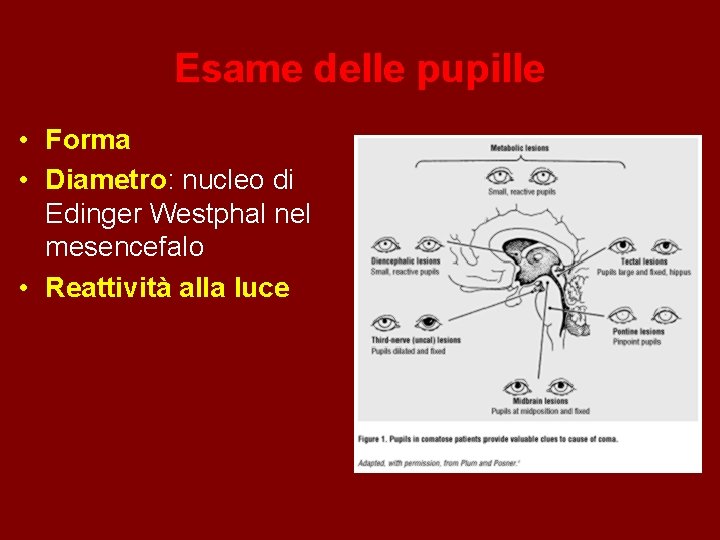 Esame delle pupille • Forma • Diametro: nucleo di Edinger Westphal nel mesencefalo •