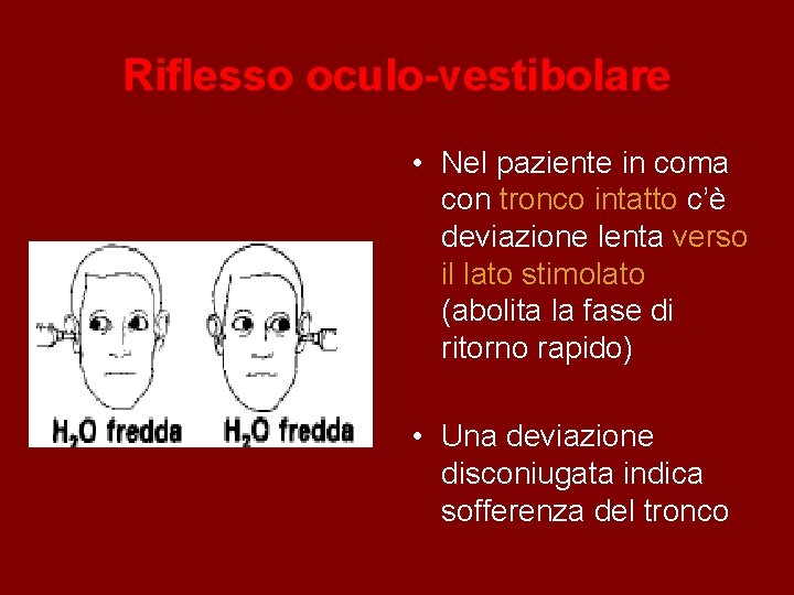 Riflesso oculo-vestibolare • Nel paziente in coma con tronco intatto c’è deviazione lenta verso