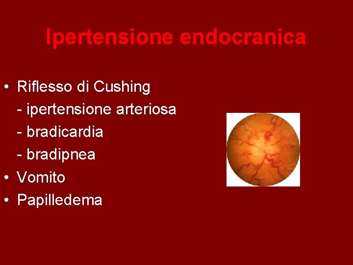Ipertensione endocranica • Riflesso di Cushing - ipertensione arteriosa - bradicardia - bradipnea •