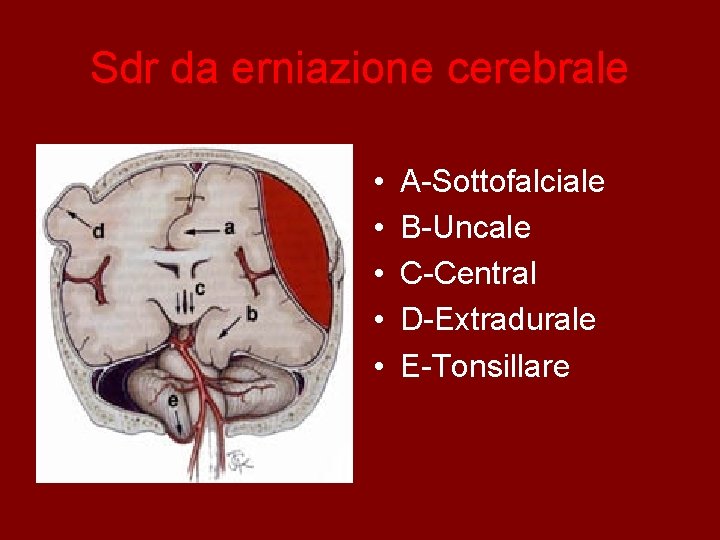 Sdr da erniazione cerebrale • • • A-Sottofalciale B-Uncale C-Central D-Extradurale E-Tonsillare 