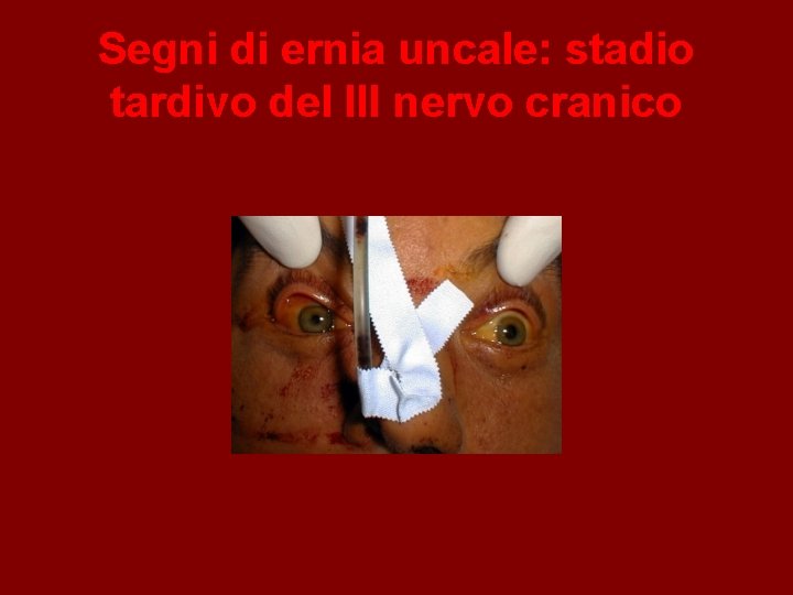 Segni di ernia uncale: stadio tardivo del III nervo cranico 