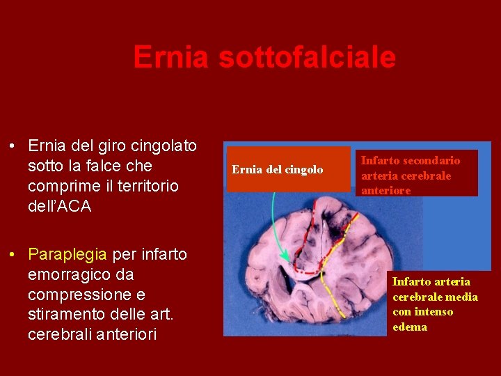 Ernia sottofalciale • Ernia del giro cingolato sotto la falce che comprime il territorio