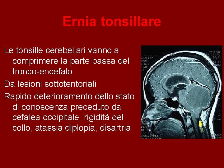 Ernia tonsillare Le tonsille cerebellari vanno a comprimere la parte bassa del tronco-encefalo Da