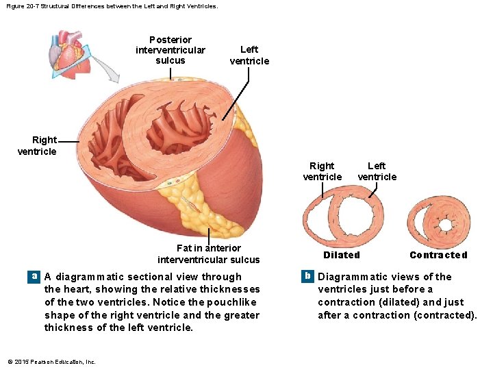 Figure 20 -7 Structural Differences between the Left and Right Ventricles. Posterior interventricular sulcus