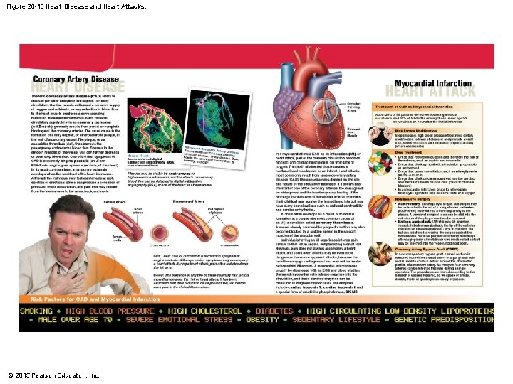 Figure 20 -10 Heart Disease and Heart Attacks. © 2015 Pearson Education, Inc. 