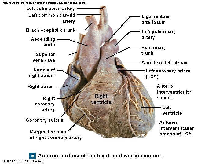 Figure 20 -3 c The Position and Superficial Anatomy of the Heart. Left subclavian