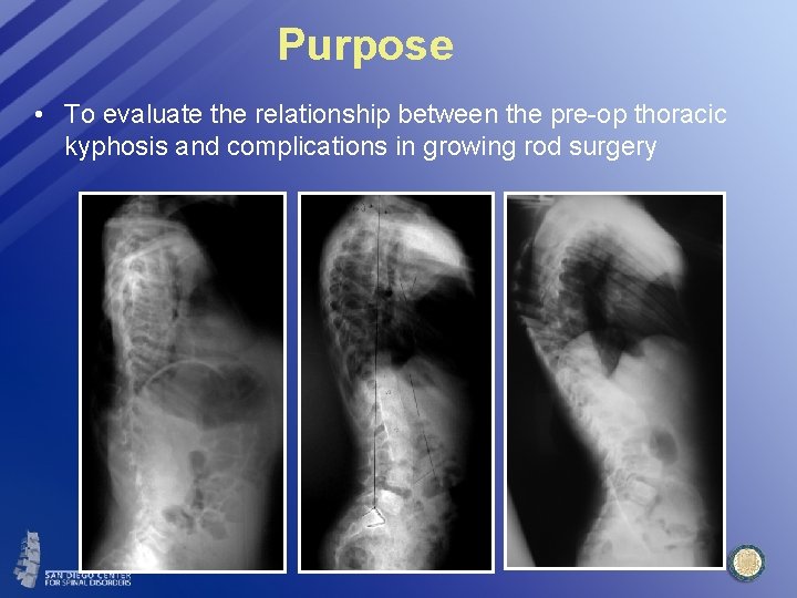 Purpose • To evaluate the relationship between the pre-op thoracic kyphosis and complications in