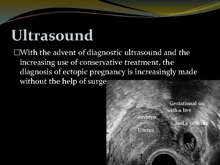 Ultrasound �With the advent of diagnostic ultrasound and the increasing use of conservative treatment,
