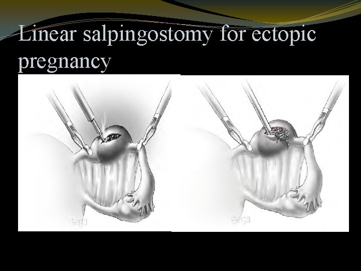 Linear salpingostomy for ectopic pregnancy 