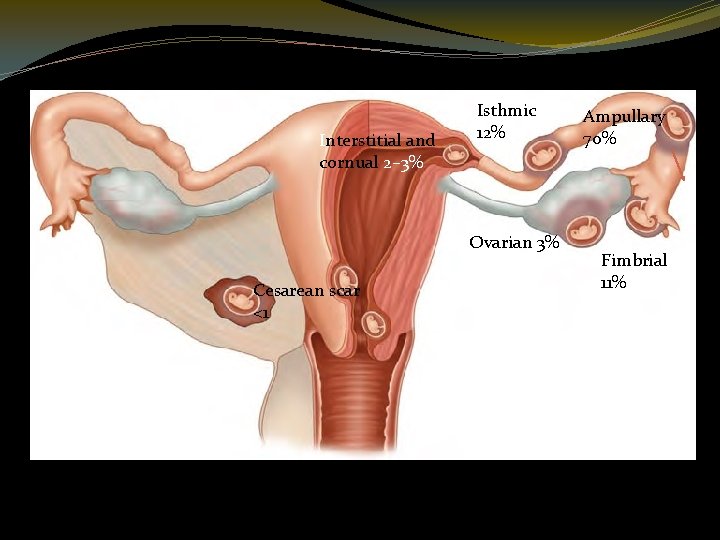 Interstitial and cornual 2– 3% Isthmic 12% Ovarian 3% Cesarean scar <1 Abdominal 1%