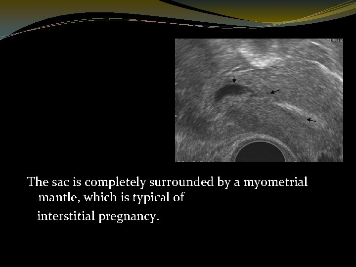 The sac is completely surrounded by a myometrial mantle, which is typical of interstitial