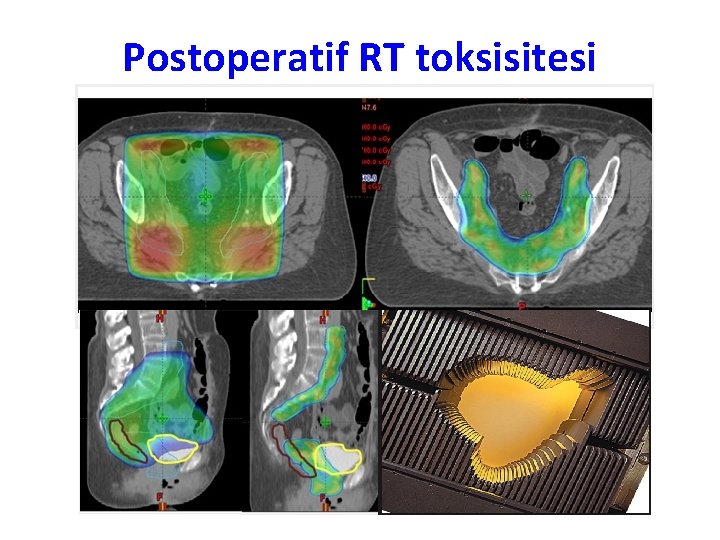 Postoperatif RT toksisitesi 