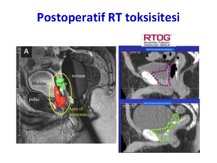 Postoperatif RT toksisitesi 