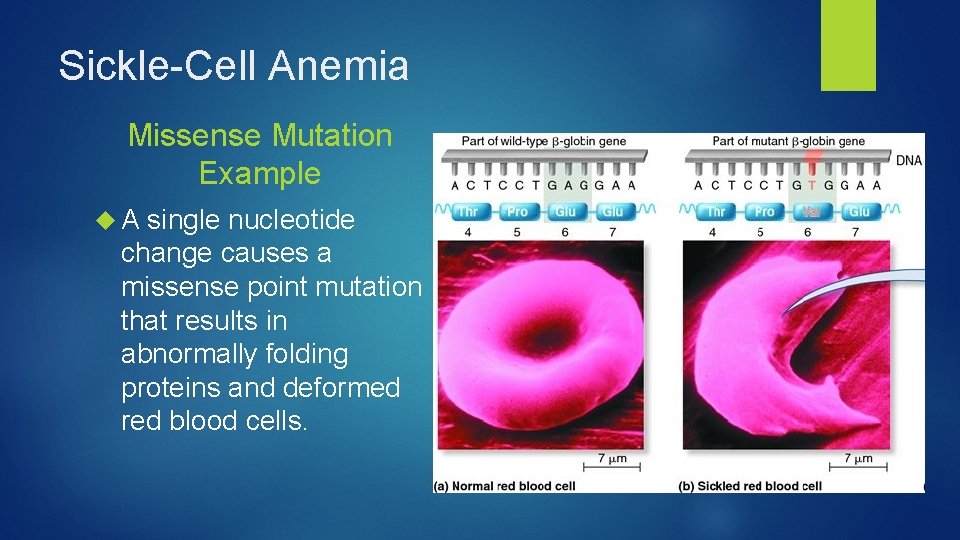 Sickle-Cell Anemia Missense Mutation Example A single nucleotide change causes a missense point mutation