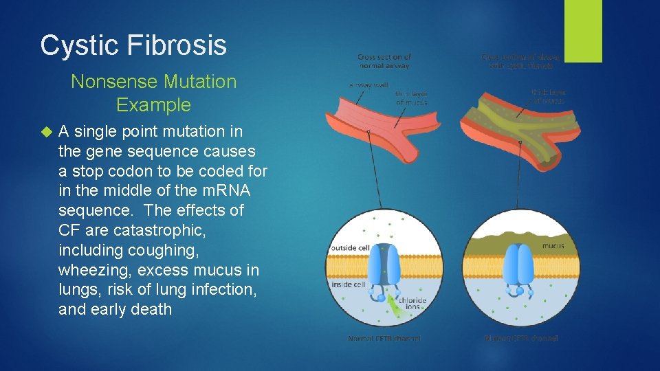 Cystic Fibrosis Nonsense Mutation Example A single point mutation in the gene sequence causes