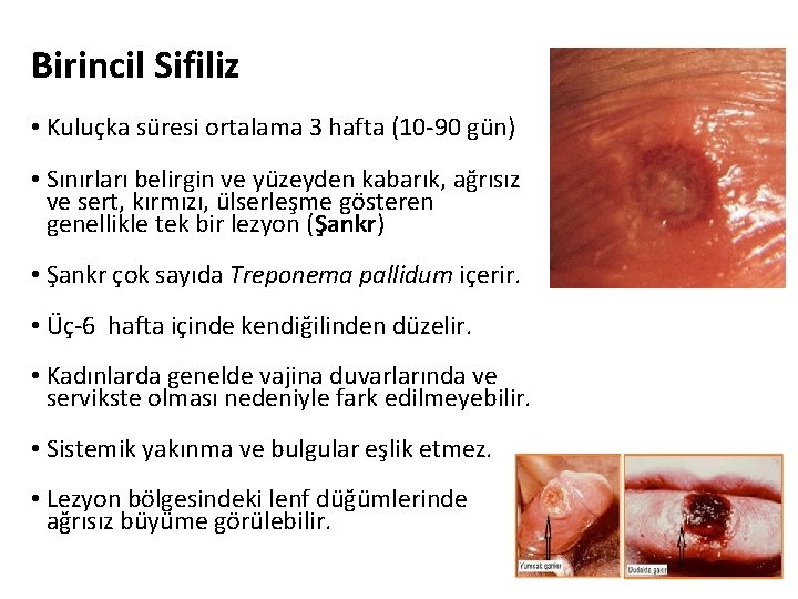 Birincil Sifiliz • Kuluçka süresi ortalama 3 hafta (10 -90 gün) • Sınırları belirgin Birincil Sifiliz • Kuluçka süresi ortalama 3 hafta (10 -90 gün) • Sınırları belirgin