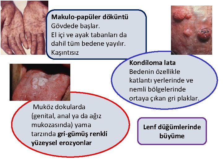 Makulo-papüler döküntü Gövdede başlar. El içi ve ayak tabanları da dahil tüm bedene yayılır.