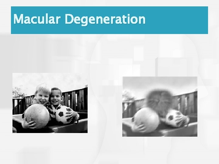 Macular Degeneration 