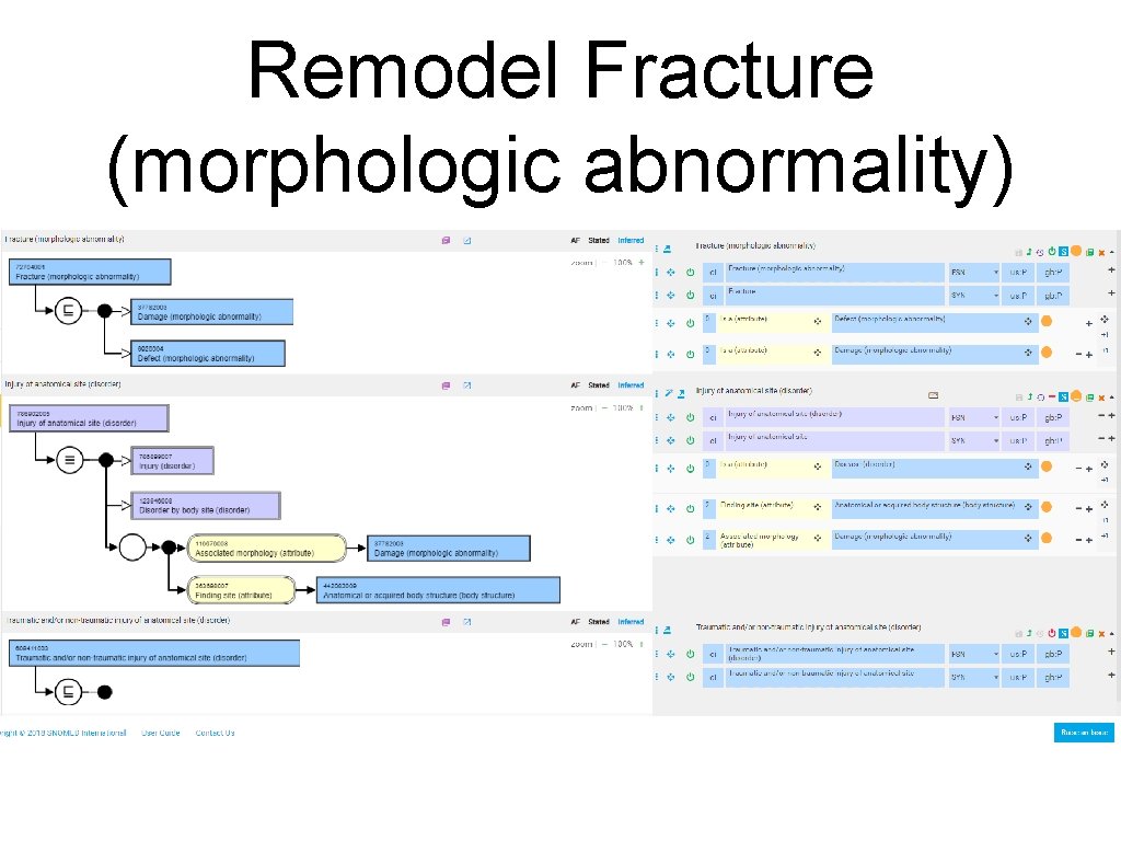 Remodel Fracture (morphologic abnormality) 