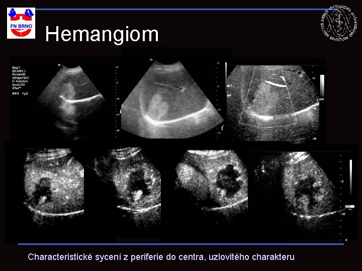 Hemangiom Characteristické sycení z periferie do centra, uzlovitého charakteru 