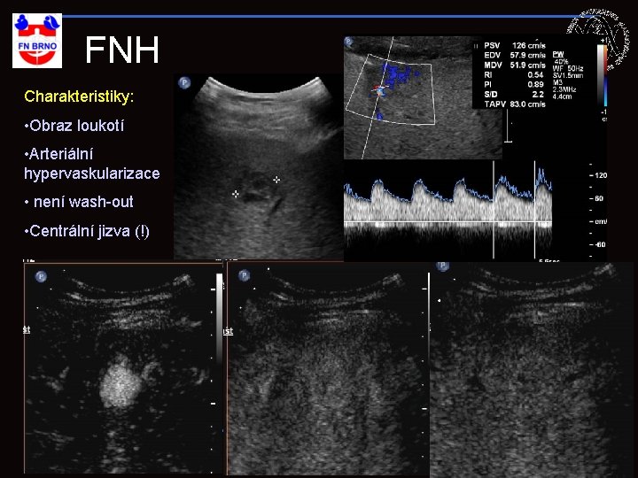FNH Charakteristiky: • Obraz loukotí • Arteriální hypervaskularizace • není wash-out • Centrální jizva