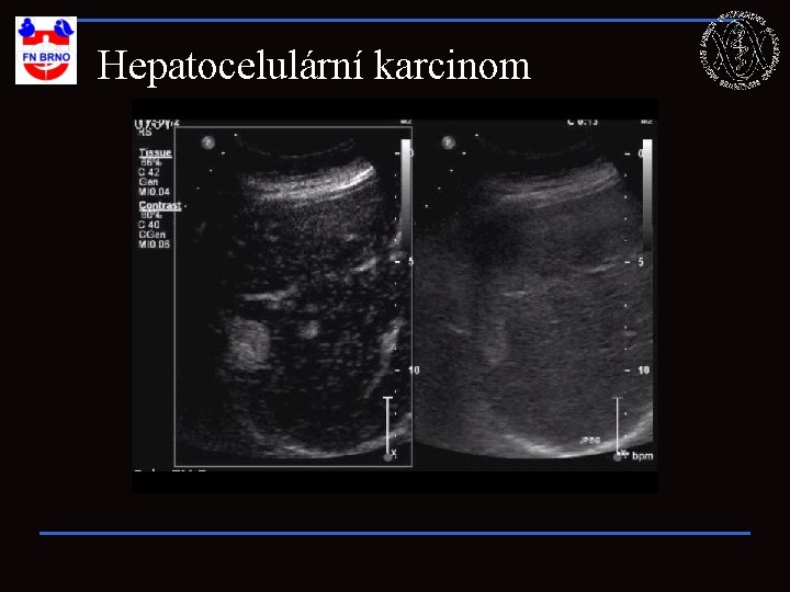 Hepatocelulární karcinom 