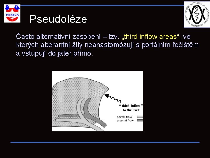 Pseudoléze Často alternativní zásobení – tzv. „third inflow areas“, ve kterých aberantní žíly neanastomózují