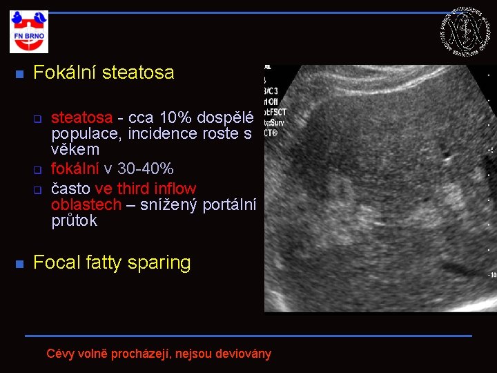 n Fokální steatosa q q q n steatosa - cca 10% dospělé populace, incidence