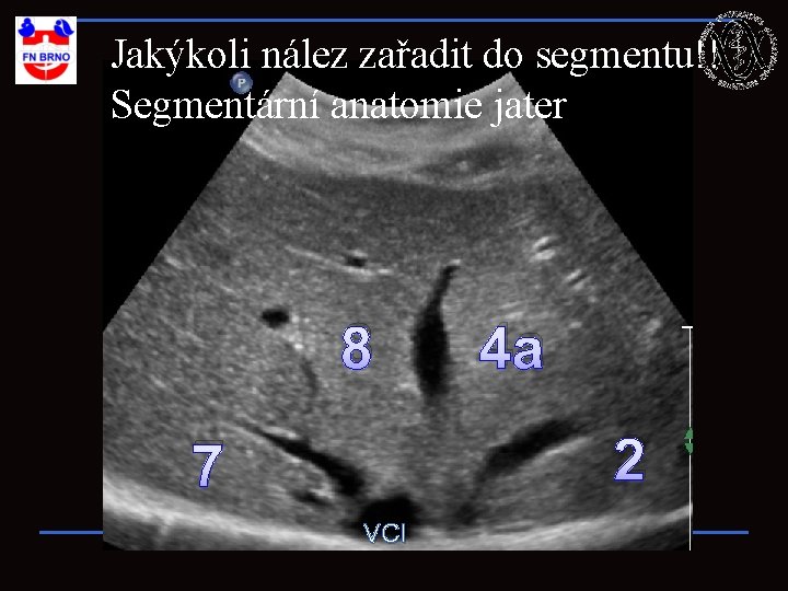 Jakýkoli nález zařadit do segmentu!! Segmentární anatomie jater 8 4 a 2 7 VCI