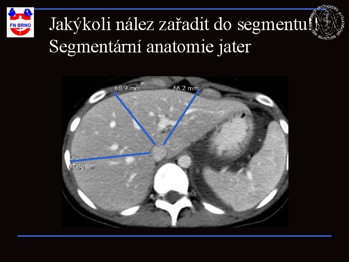 Jakýkoli nález zařadit do segmentu!! Segmentární anatomie jater 