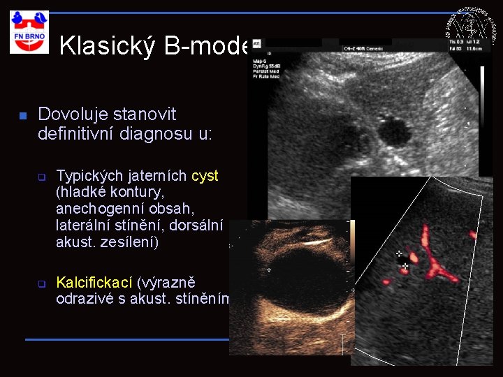 Klasický B-mode: n Dovoluje stanovit definitivní diagnosu u: q q Typických jaterních cyst (hladké