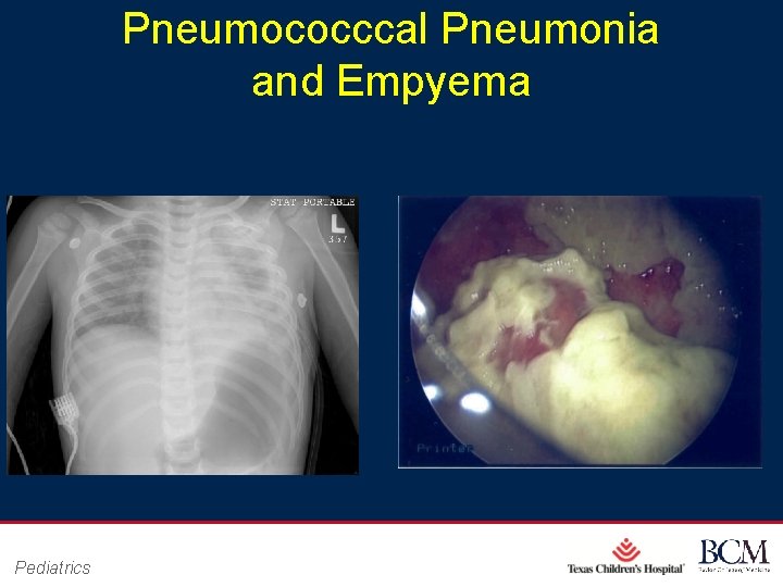 Pneumococccal Pneumonia and Empyema Pediatrics Page 31 xxx 00. #####. ppt 10/24/2020 4: 49: