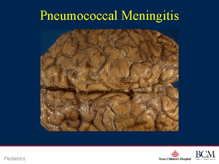 Pneumococcal Meningitis Pediatrics Page 37 xxx 00. #####. ppt 10/24/2020 4: 49: 24 PM