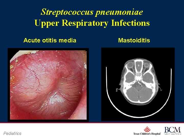 Streptococcus pneumoniae Upper Respiratory Infections Acute otitis media Pediatrics Mastoiditis Page 42 xxx 00.