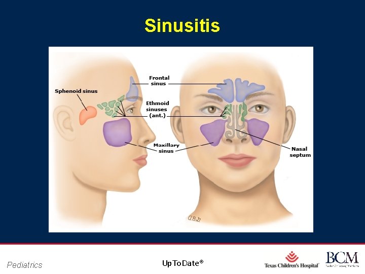Sinusitis Pediatrics Page 48 Up. To. Date® xxx 00. #####. ppt 10/24/2020 4: 49: