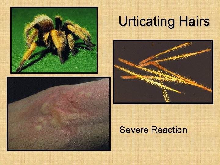 Urticating Hairs Severe Reaction 