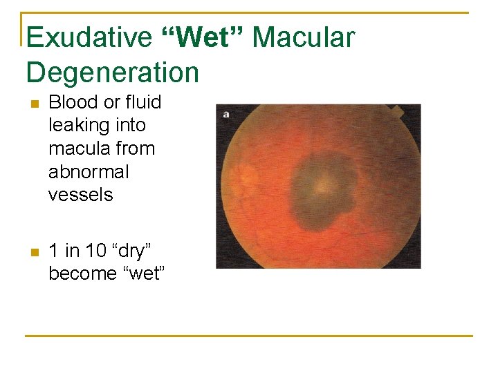 Exudative “Wet” Macular Degeneration n Blood or fluid leaking into macula from abnormal vessels