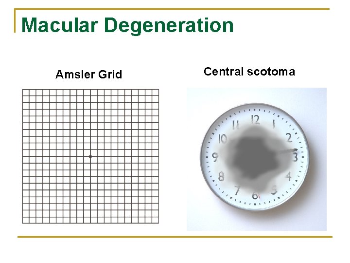 Macular Degeneration Amsler Grid Central scotoma 