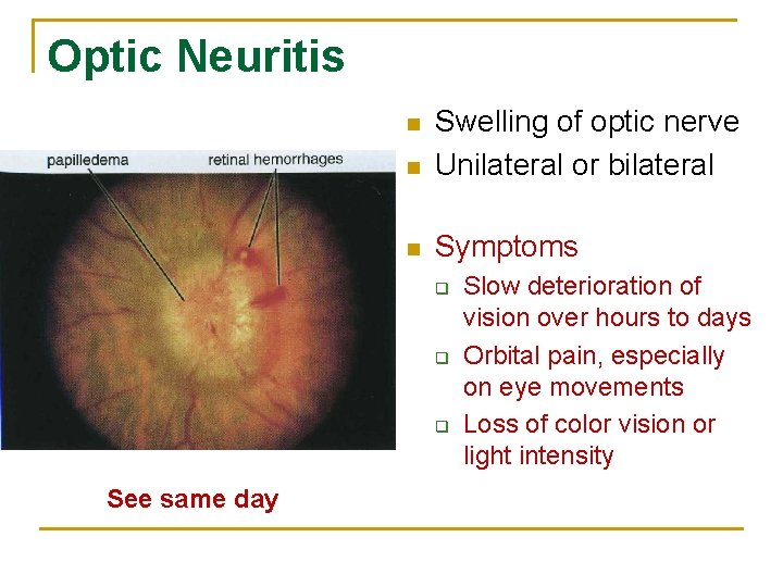 Optic Neuritis n Swelling of optic nerve Unilateral or bilateral n Symptoms n q