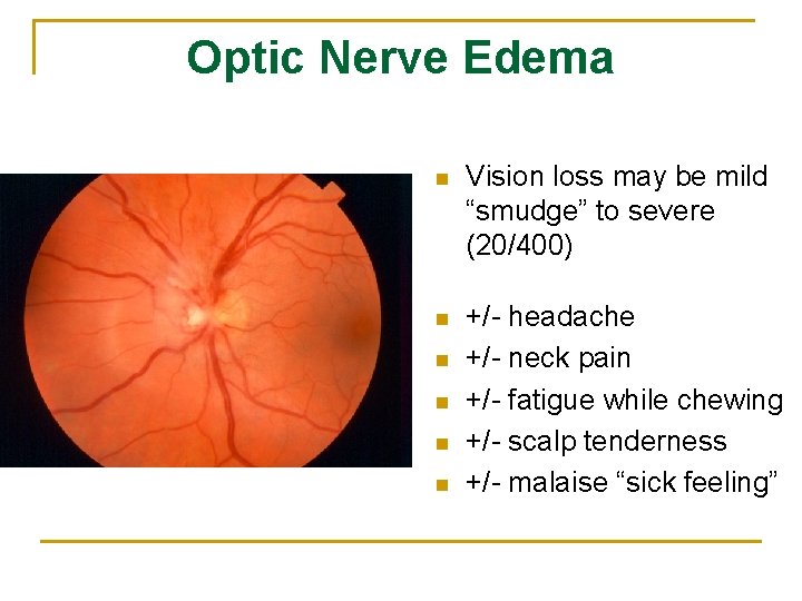 Optic Nerve Edema n Vision loss may be mild “smudge” to severe (20/400) n