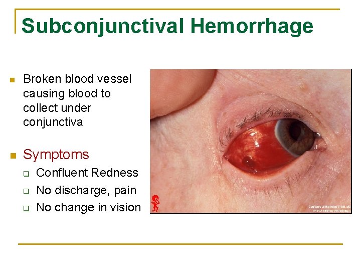 Subconjunctival Hemorrhage n n Broken blood vessel causing blood to collect under conjunctiva Symptoms