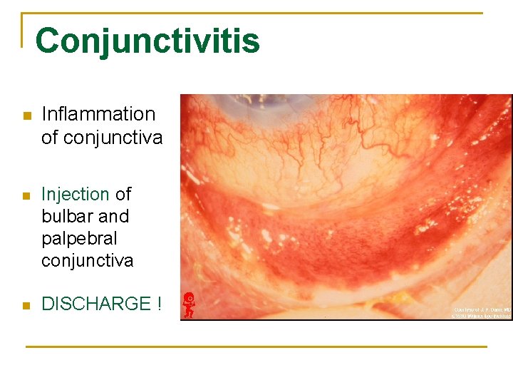 Conjunctivitis n Inflammation of conjunctiva n Injection of bulbar and palpebral conjunctiva n DISCHARGE