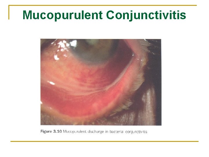 Mucopurulent Conjunctivitis 